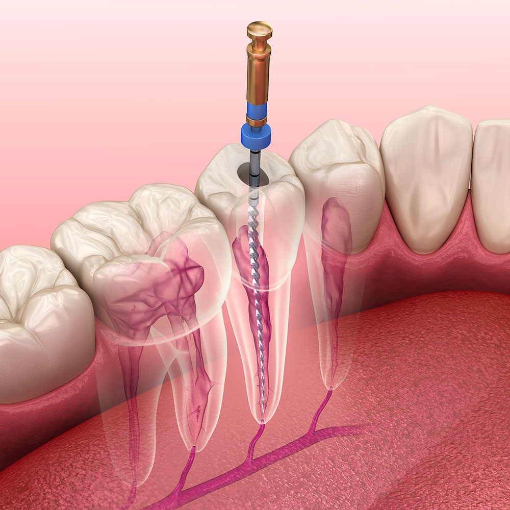 Atelier Endodontie Mécanisée